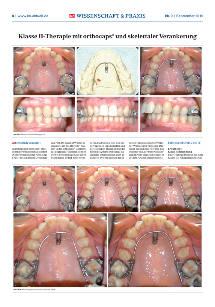 Klasse II-therapie mit orthocaps